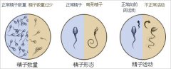 精子畸形不育治疗南京哪里好