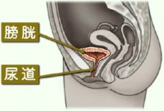 膀胱炎主要疗法一般有哪些