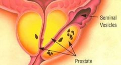 前列腺钙化对身体的危害有哪些